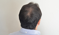 男性の毛髪治療image