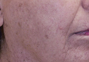 頬IPL光治療（BBLフォトブライト）施術前image