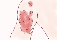 乳児血管腫‐いちご状血管腫