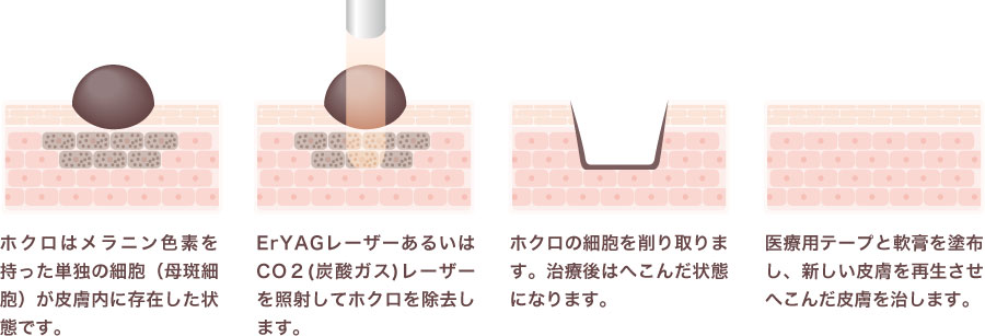 ほくろの治療法～レーザー治療と手術治療について～