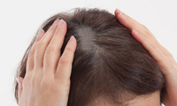 女性の毛髪治療image