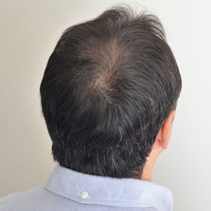 男性の毛髪治療（AGA）image