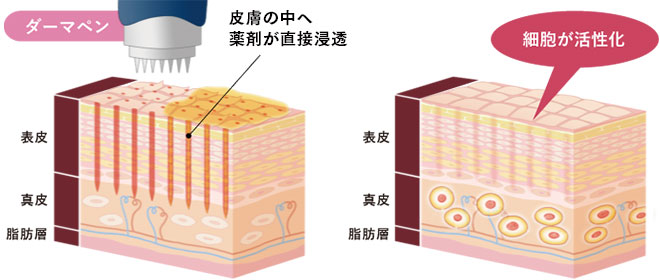 ダーマペン概念図image