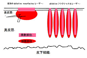 フラクショナルレーザー概念図