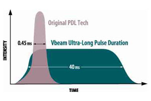 Vbeamレーザーの特徴image