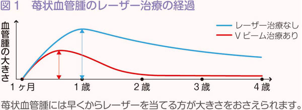 いちご状血管腫のレーザー治療の経過