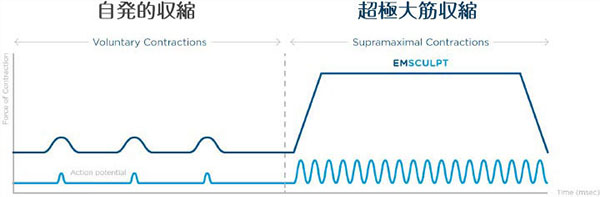 HIFEM　超極大筋収縮image