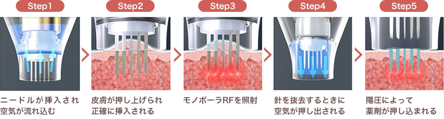POTENZA®【ポテンツァ】（マイクロニードルRF治療機器） image