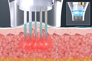 自費診療［POTENZA®【ポテンツァ】（マイクロニードルRF治療機器