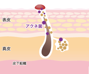 開き毛穴image