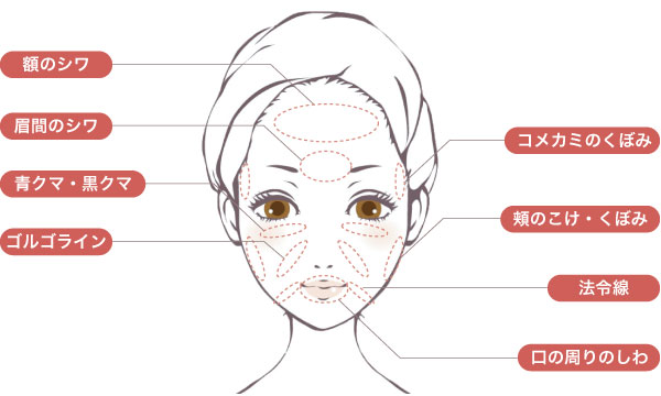 ベビーコラーゲン注入で改善できる症状シェーマ