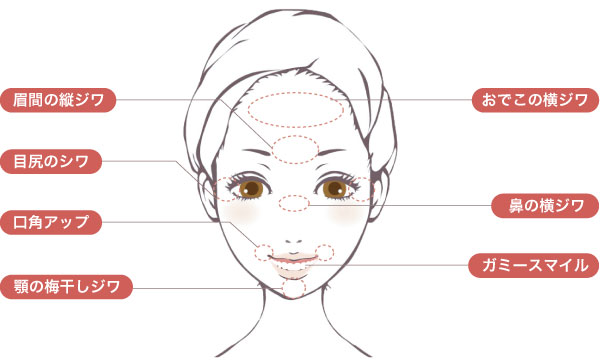 ボツリヌストキシン（ボトックス）注入で改善できる症状シェーマ