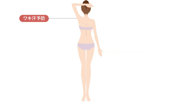 多汗症ボツリヌストキシン（ボトックス）治療で改善できる症状シェーマ