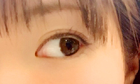瞼の手術image