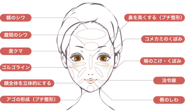 ヒアルロン酸注入で改善できる症状image