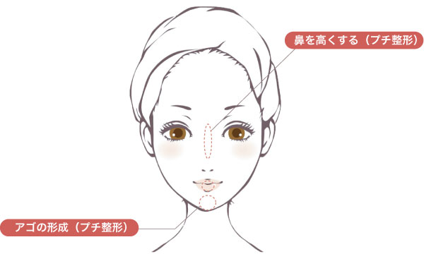 ハイドロキシアパタイト製剤（レディエッセ®）注入で改善できる症状シェーマ