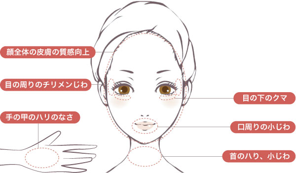 スネコス注射で改善できる症状シェーマ