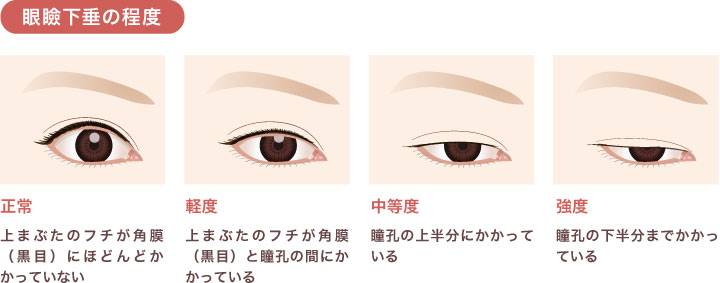 眼瞼下垂の程度image