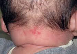 赤あざ（単純性血管腫）ウンナ母斑image