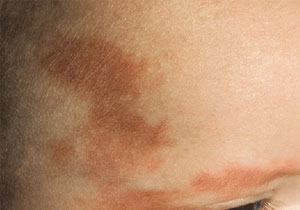 赤あざ（単純性血管腫）単純性血管腫・先天性血管腫・ポートワイン母斑image
