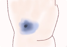 体の青あざ‐青色母斑