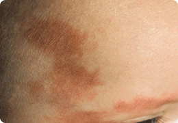 単純性血管腫・先天性血管腫・ポートワイン母斑