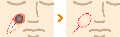皮膚腫瘍切除術＋皮弁形成術