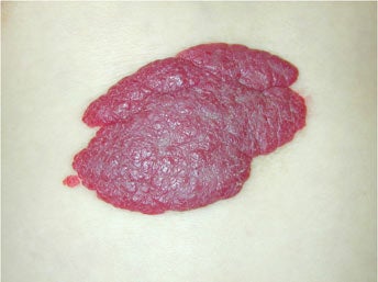 赤あざ①：いちご状血管腫治療について