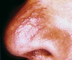 血管病変：毛細血管拡張症の治療