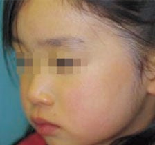 太田母斑（顔・目の周りの青あざ）の治療