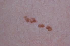 ぶつぶつした茶色いあざ：表皮母斑について