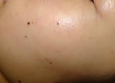 黒いあざ：母斑細胞性母斑・色素性母斑・獣皮様母斑について