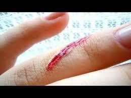 すり傷・切り傷のお話