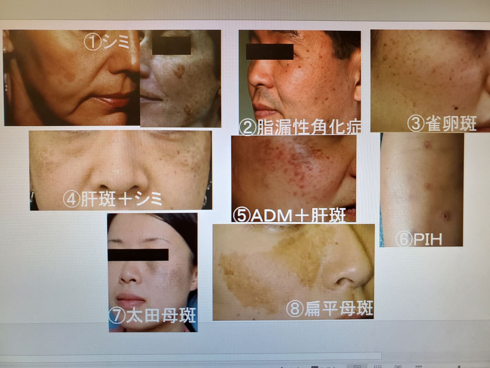 シミについて　～種類と鑑別