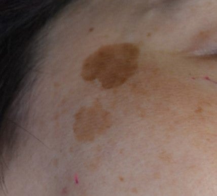 シミ治療②　肝斑の原因と治療法