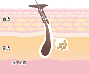 毛穴について②　それぞれの治療法