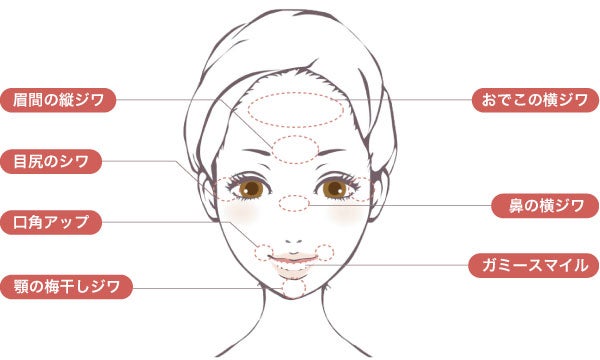 しわの治療　ボトックスとヒアルロン酸の違い