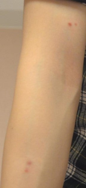 からだ（首から下）のほくろ治療について