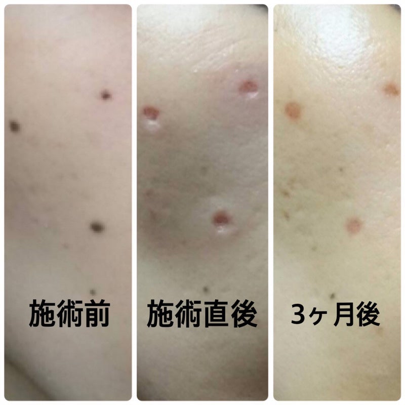 ホクロやシミレーザー治療後のアフターケアと診察