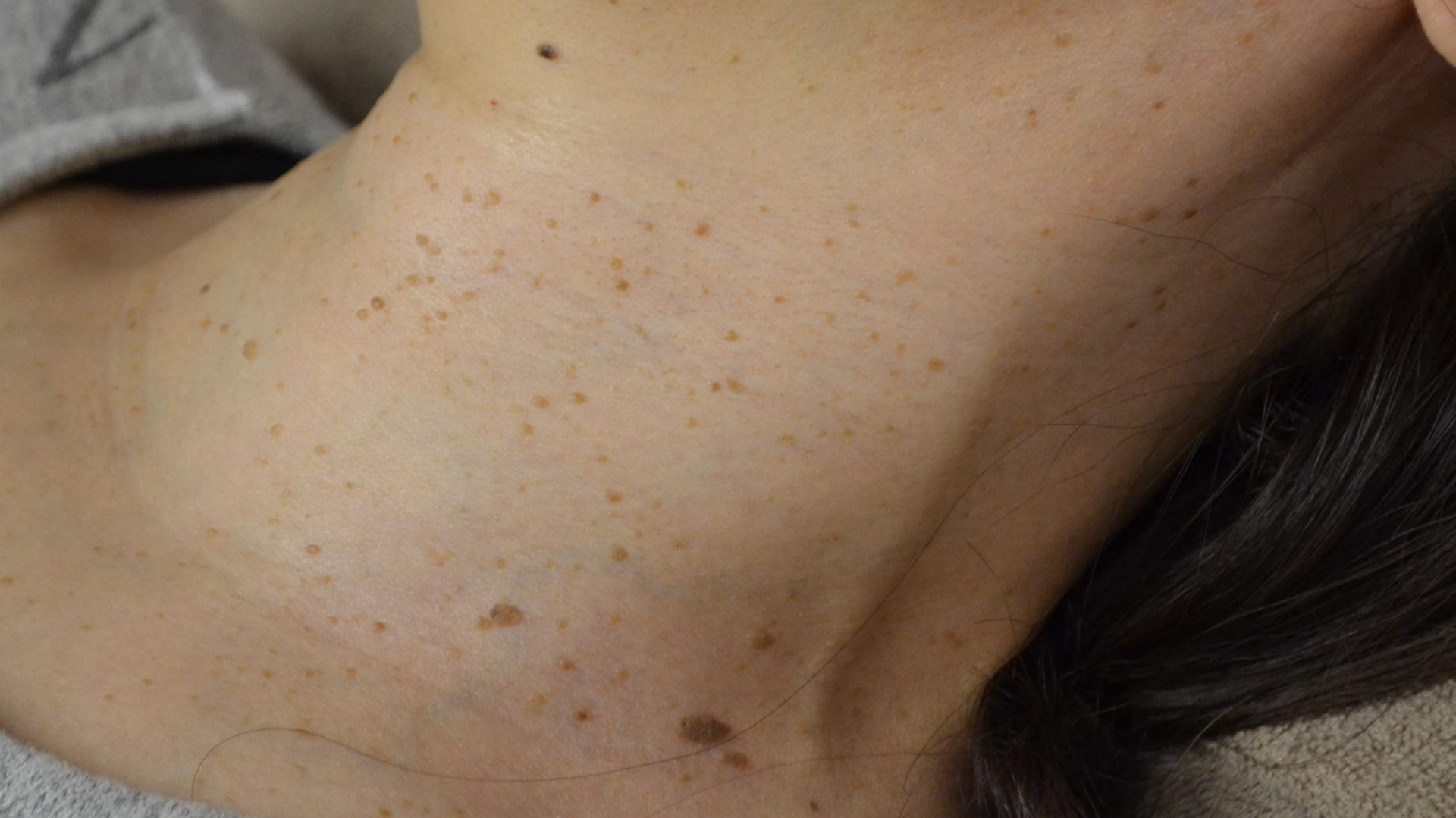 手や首のアンチエイジング①シミやイボ